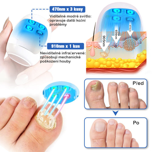 Furzero™ Hřebíky Fungus Čisticí laser Zařízení pro úlevu