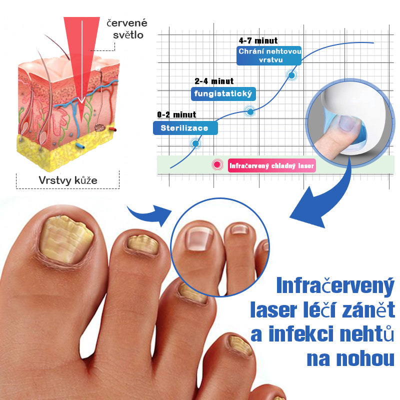 Furzero™ Hřebíky Fungus Čisticí laser Zařízení pro úlevu